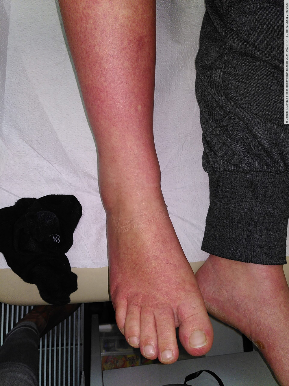 Abb4_Makuloeses-Exanthem-bei-Dengue-scaled