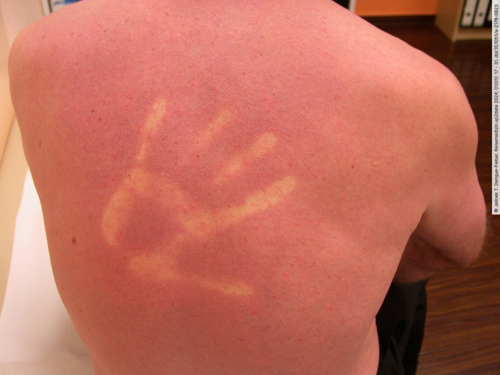 Abb5_Makuloeses-Exanthem-und-Dermografismus-bei-Dengue-Fieber